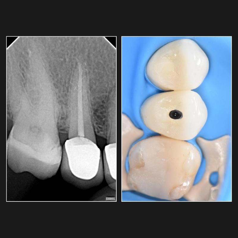 Endodoncia1
