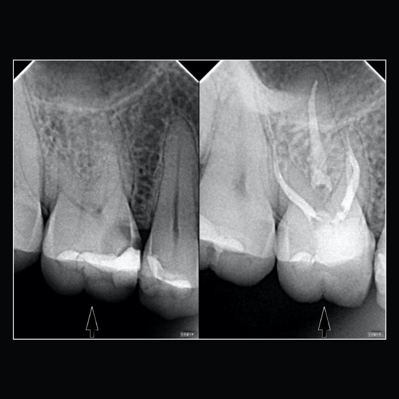 Endodoncia2